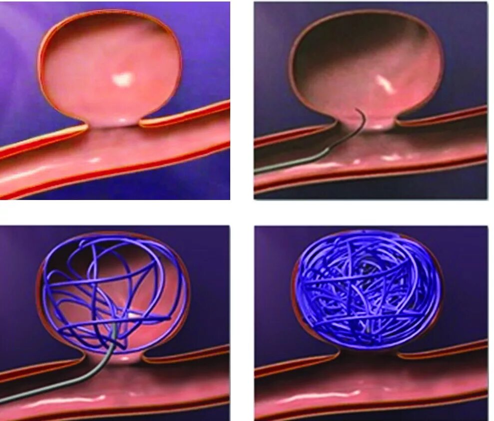 Аневризма головного мозга эндоваскулярным. Эмболизация аневризма головного мозга. Эндоваскулярная спиральная эмболизация. Эндоваскулярное эмболизация аневризмы головного мозга что это такое. Эндоваскулярная эмболизация сосудов.
