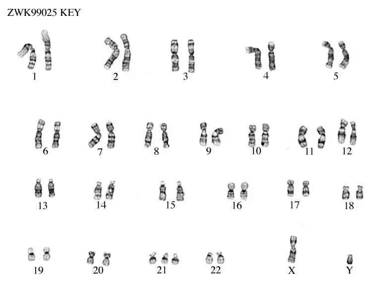 Синдром дауна лишняя хромосома. Кариотип при синдроме Дауна. Кариограмма хромосом синдром Дауна. Синдром Дауна 21 хромосома. Кариотип человека с синдромом Дауна.
