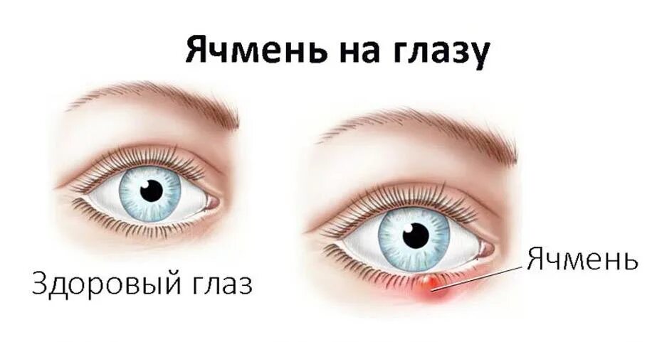 Чем можно вылечить ячмень. Заболевания век ячмень.