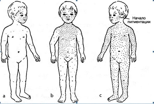 Этапность появления сыпи при кори тест. Высыпания корь краснуха ветрянка. Корь краснуха скарлатина сыпь сыпь.