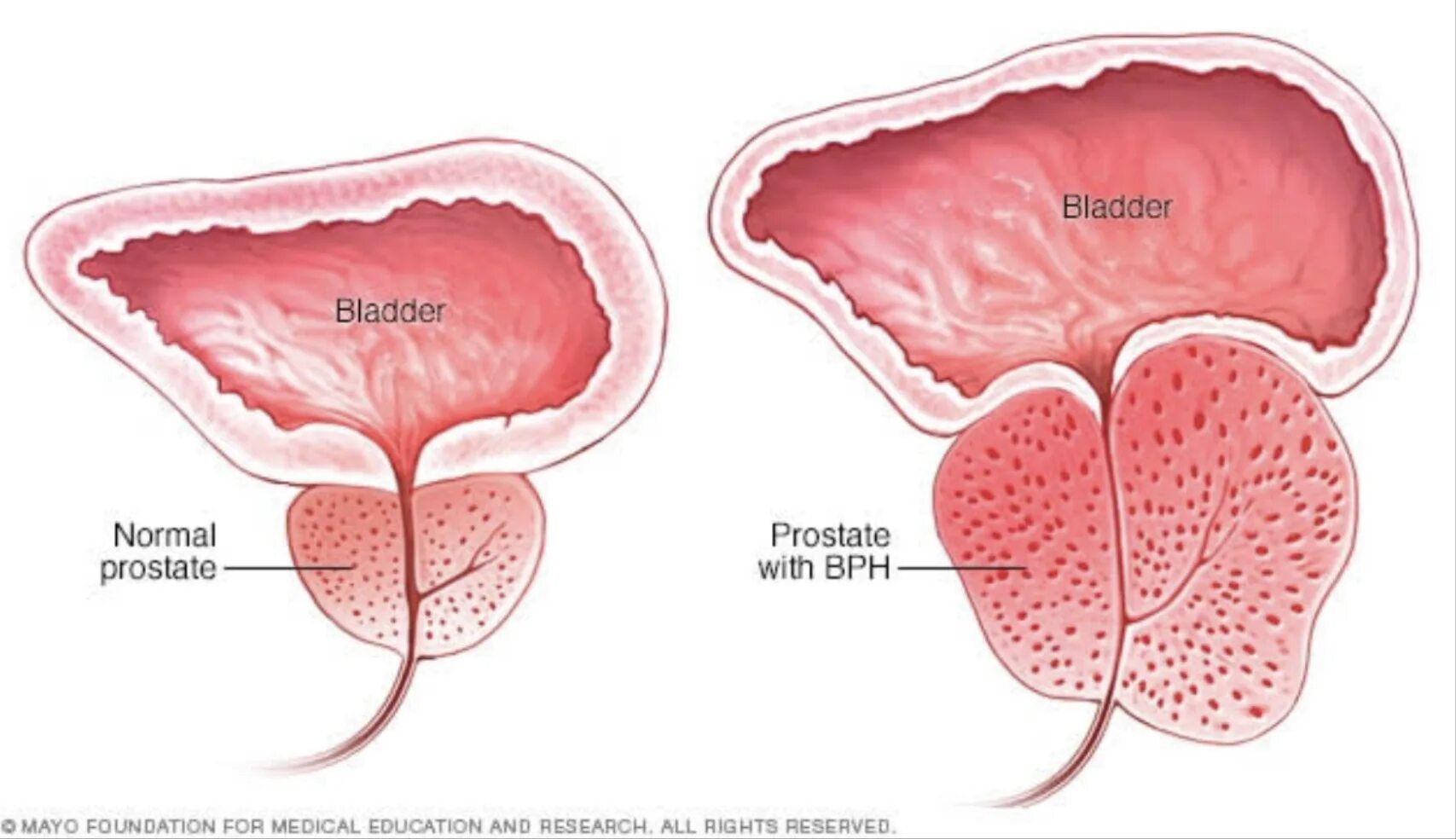 Аденома предстательной железы мочеиспускание. Аденома предстательной железы. Аденома предстательной железы мочеиспускание. Увеличенная предстательная железа. Предстательная железа, prostata.