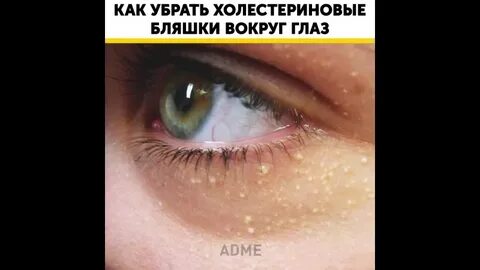 Как убрать бляшки