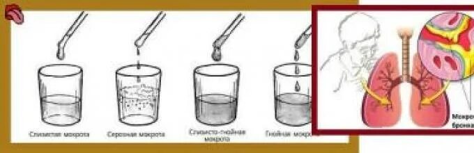 Плохо отходит мокрота что делать. Схема отхождения мокроты. Трудноотделяемая мокрота. Мокрота схема.