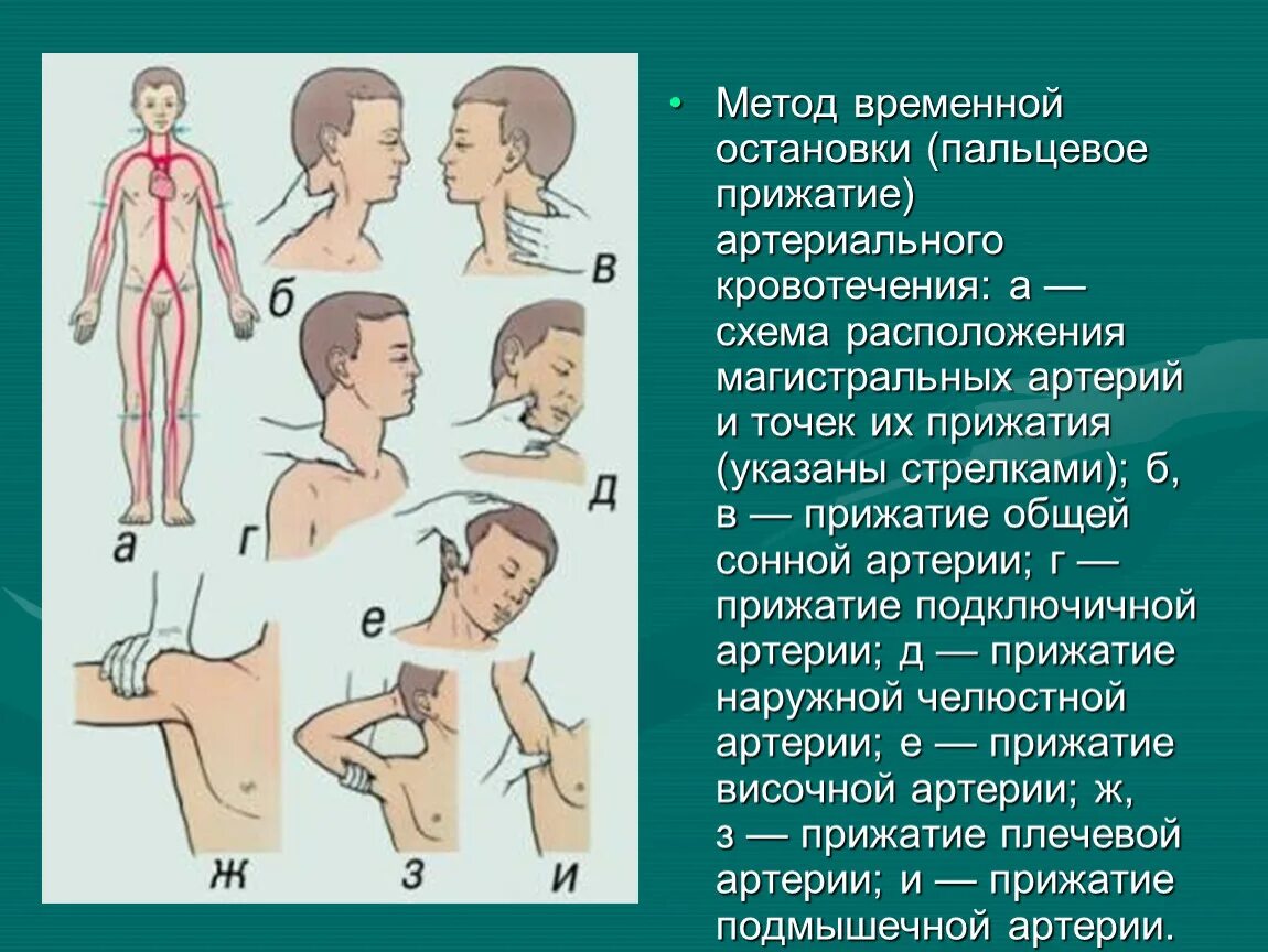 Остановка артериального кровотечения прижатие артерий. Остановка кровотечения из сонной артерии (пальцевое прижатие).. Остановка артериального кровотечения методом пальцевого прижатия. Метод временной остановки кровотечения - пальцевого прижатия. Останавливать кровотечение путем