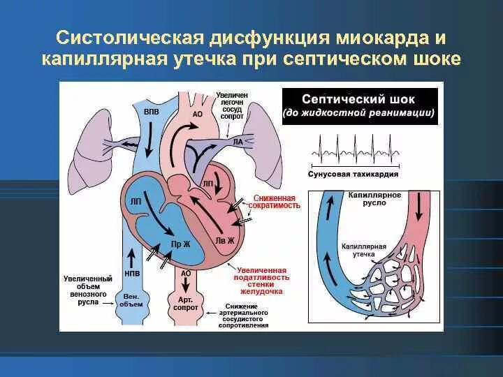 Дисфункция миокарда. Систолическая дисфункция. Миокардиальная дисфункция. Систолическая дисфункция миокарла левой желудочка.