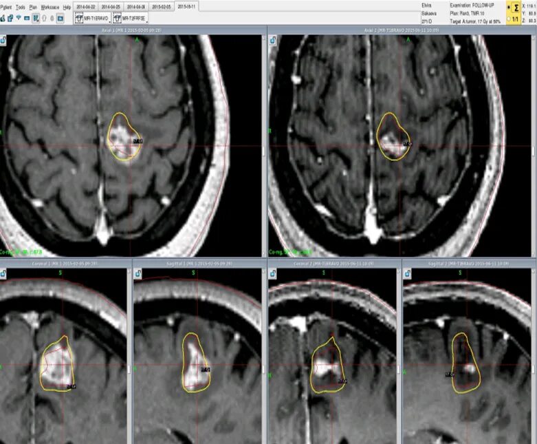 Глиома лечение. Глиобластома мозжечка мрт. Глиобластома головного мозга на кт. Опухоль головного мозга снимок мрт.