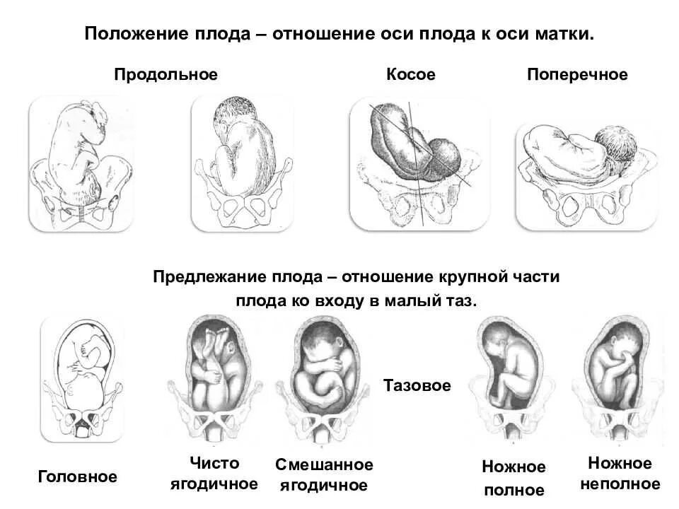 Что означает предлежание. Головное предлежание косое положение плода. Положение плода продольное головное 1 позиция. Положение продольное тазовое 2 позиция. Продольное головное предлежание плода 32 недели беременности.