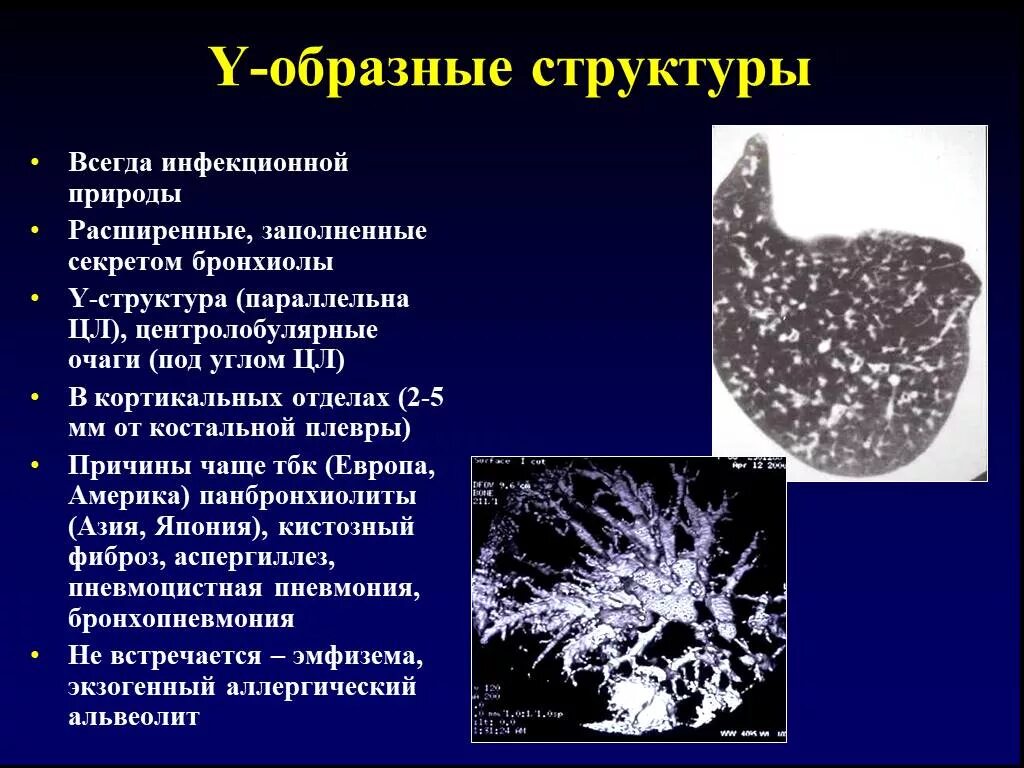 Очаги по типу дерева в почках. Очаги дерево в почках кт. y образные структуры в легких. y-образные расширения бронхиол на кт это. y образные структуры в легких кт.