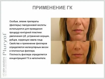 Филлер применение