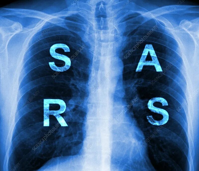 Severe acute