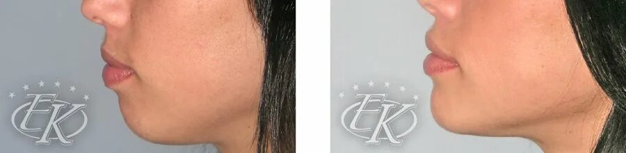 Маленький подбородок. Подбородок без подбородочного выступа. Подбородок без подбородочного выступа. Лицо со скошенным подбородком. Ментопластика челюсти.