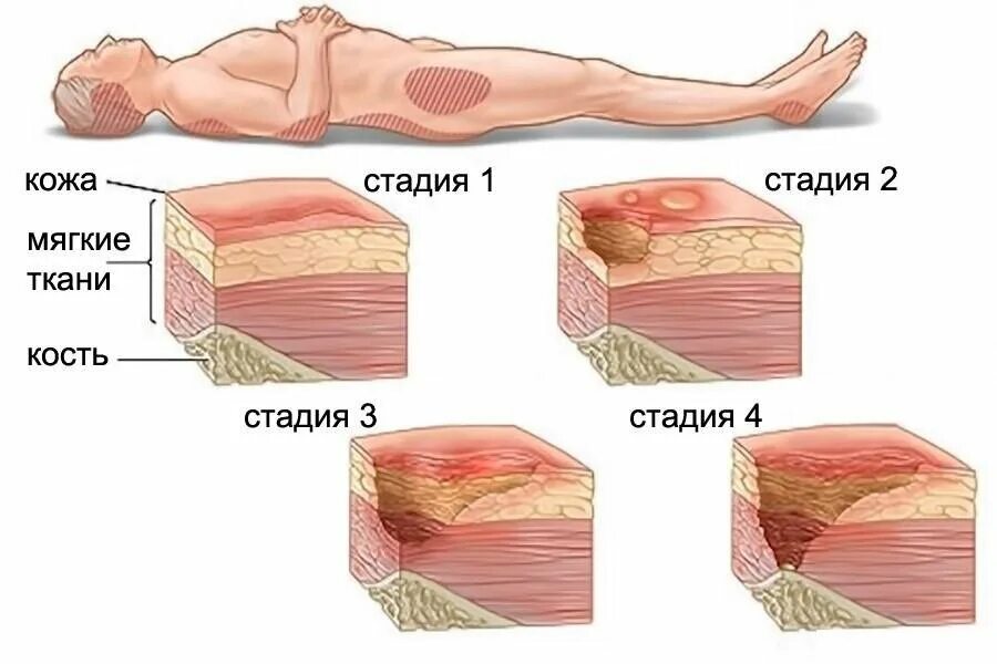 Как вылечить пролежни. Декубитальная язва пролежни. струпьевидные пролежни. первая степень пролежней.