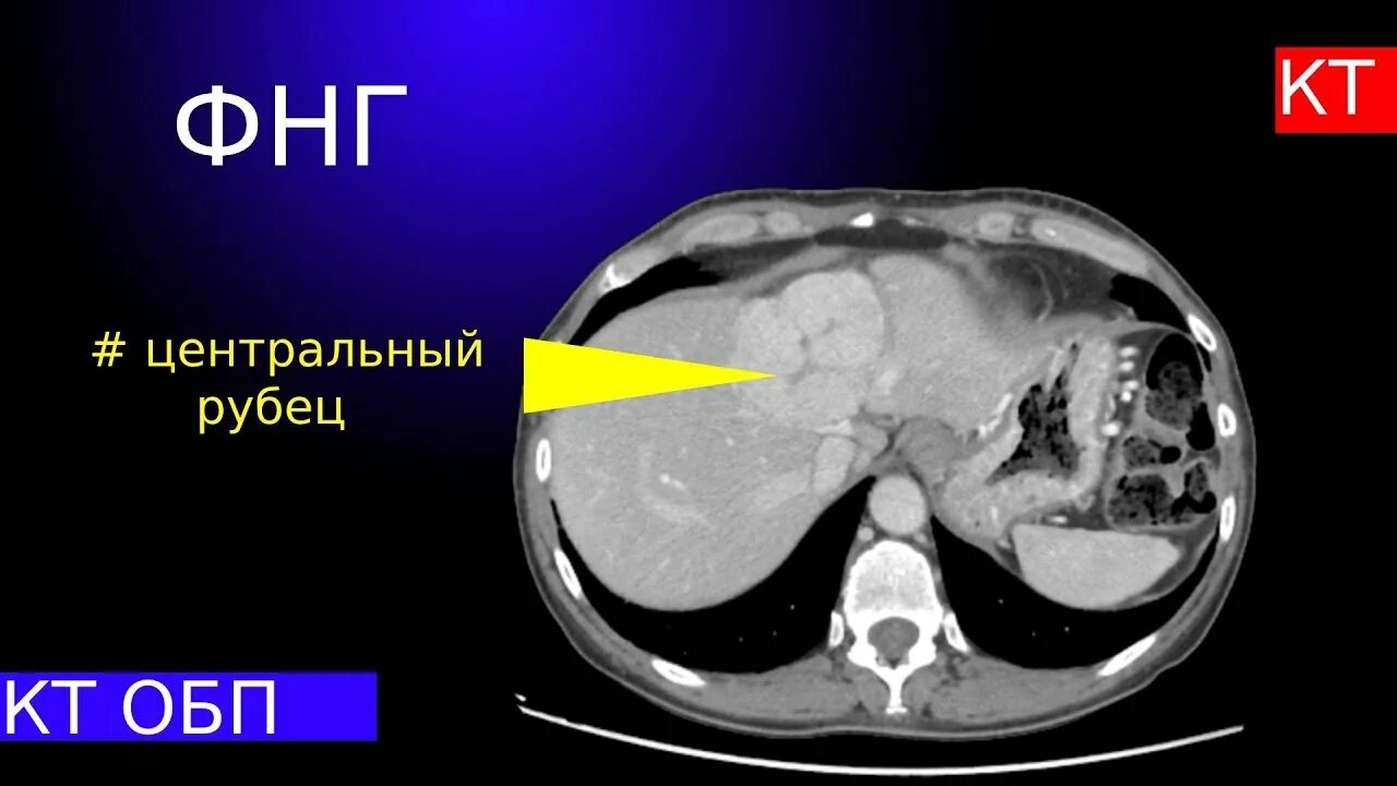 Фокальная гиперплазия печени. Нодулярная гиперплазия кт. Фокальная нодулярная гиперплазия печени на кт. Нодулярная гиперплазия печени на кт.