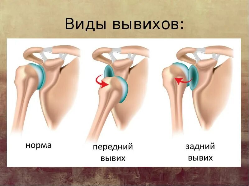 Что делать при вывихе сустава