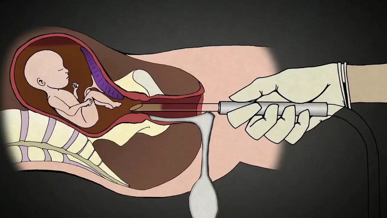 После вакуума можно забеременеть. Мини-аборт (вакуум-аспирация). Метод вакуумной аспирации. Вакуумный аборт на ранних. Вакуумный аборт (мини-аборт).