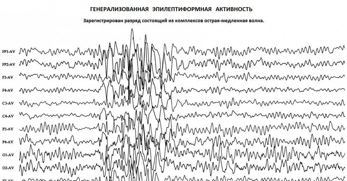 Диффузная эпилептиформная активность. Генерализованная Спайк волна на ЭЭГ. Эпи активность у детей на ЭЭГ. Энцефалограмма эпилептические активность. Генерализованная эпилептиформная активность на ЭЭГ У ребенка.