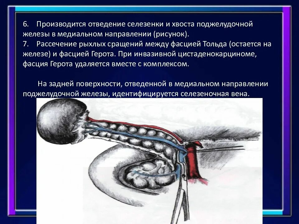 Операции на селезенке. Резекция хвоста поджелудочной железы. Фасции поджелудочной железы. Корпорокаудальная резекция поджелудочной. Операции на поджелудочной железе.