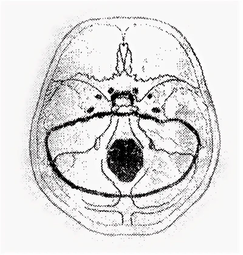Для перелома основания черепа характерно. Кольцевидный перелом основания черепа. Перелом основания черепа схема. Кольцевой перелом основания черепа. Перелом свода основания черепа.