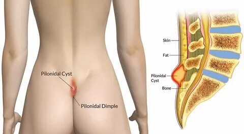 What is a pilonidal cyst 