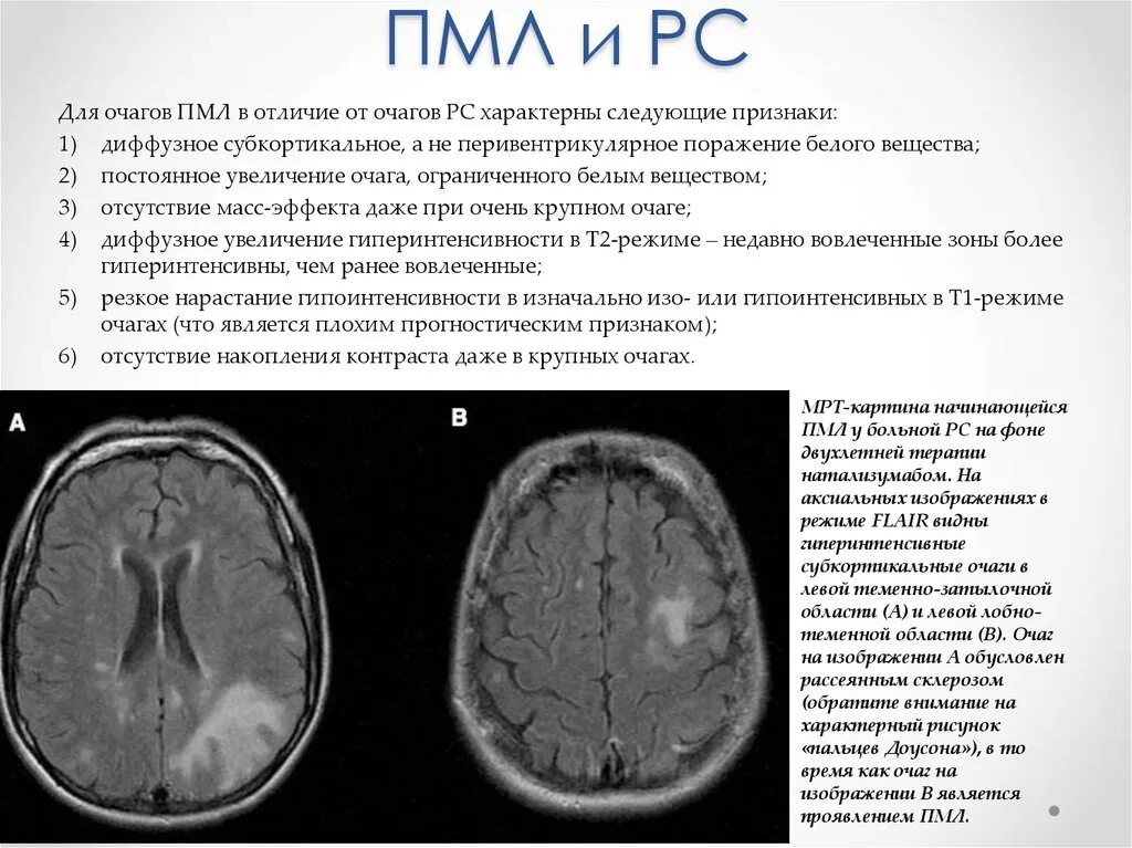 Прогрессирующая мультифокальная лейкоэнцефалопатия мрт. Лейкоэнцефалопатия головного мозга мрт. Прогрессирующая мультифокальная лейкоэнцефалопатия кт. Поражение белого вещества мозга