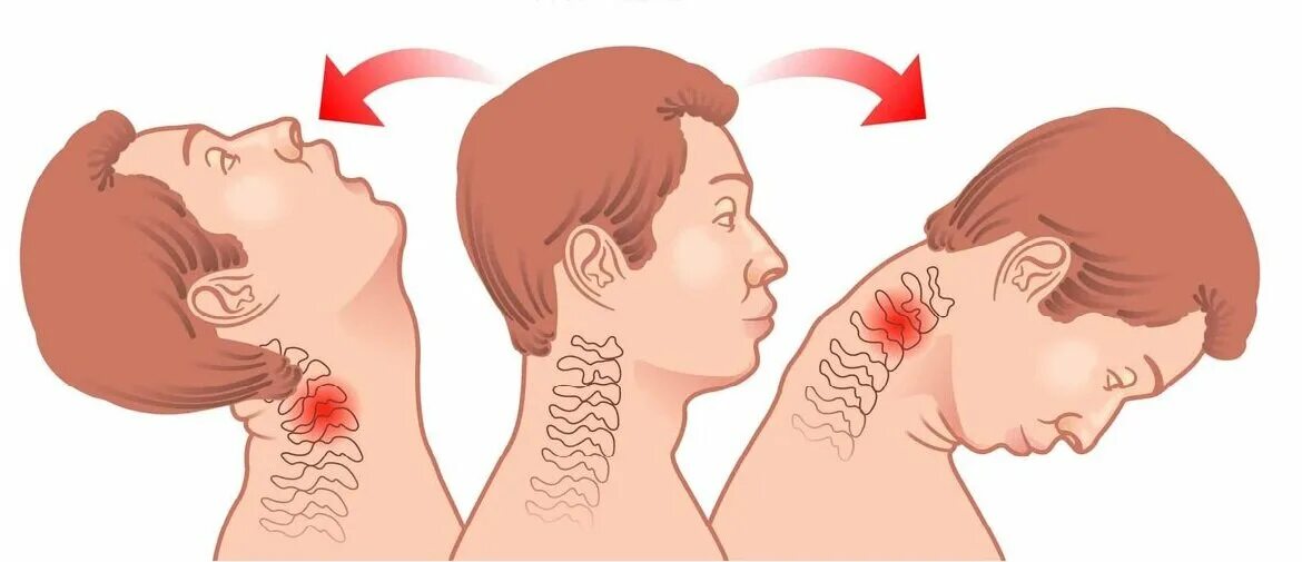 Дышать в затылок. Хлыстовая травма шейного отдела позвоночника. Хлыстовой перелом шейных позвонков. Хлыстообразные переломы шейного отдела. Хлыстовой перелом шейного отдела позвоночника возникает.