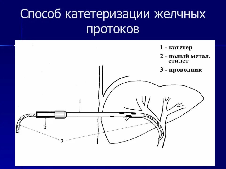 Катетер желчного пузыря