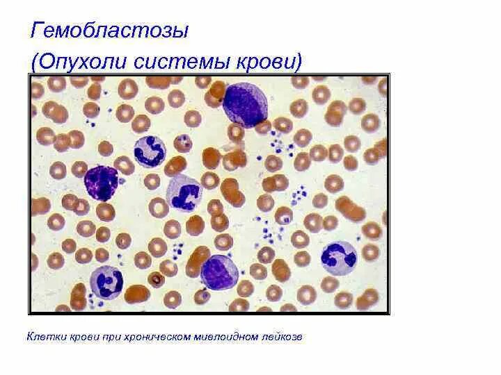 Опухоли системы крови. Доброкачественные опухоли системы крови. Гемобластозы патологическая анатомия. Опухоли системы крови патологической анатомии. Опухоль клеток крови