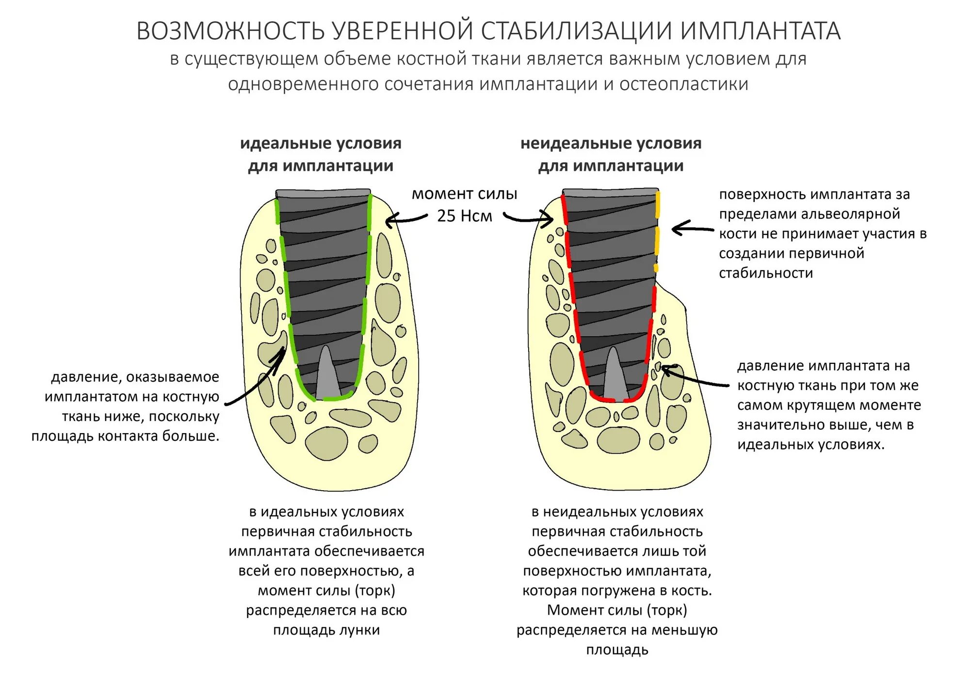 Костная пластика при имплантации. Имплантация при недостатке костной ткани. Germant bone graft. Reamer–irrigator–aspirator bone graft harvesting. Первичная стабилизация имплантата это.