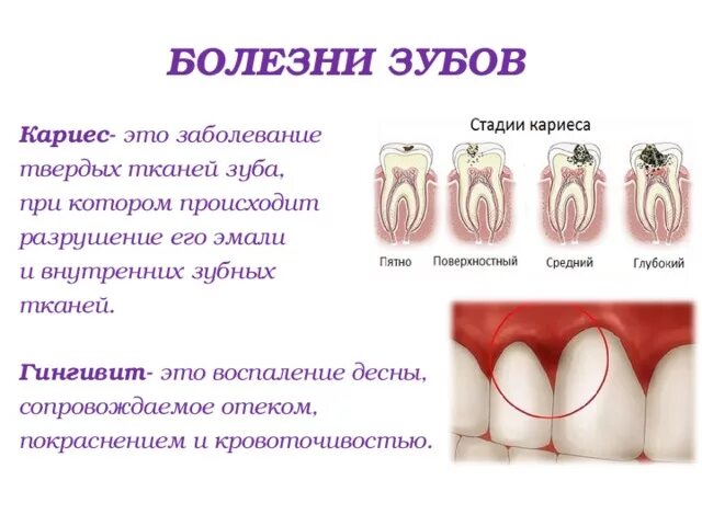 Передается ли кариес поцелуем. Бывает ли кариес сбоку зуба. Пришеечный кариес фронтальных зубов. Таблица поражением кариесов зубов. Распространенные болезни зубов.