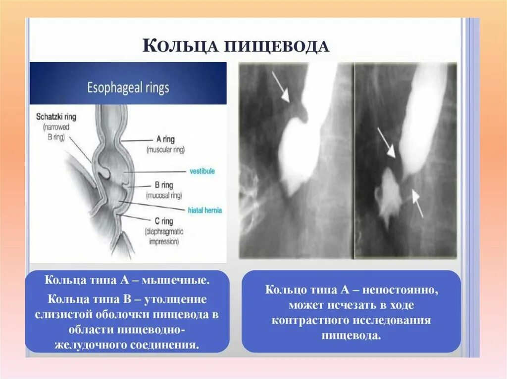 Кольца пищевода