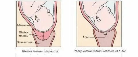 Короткая шейка матки причины