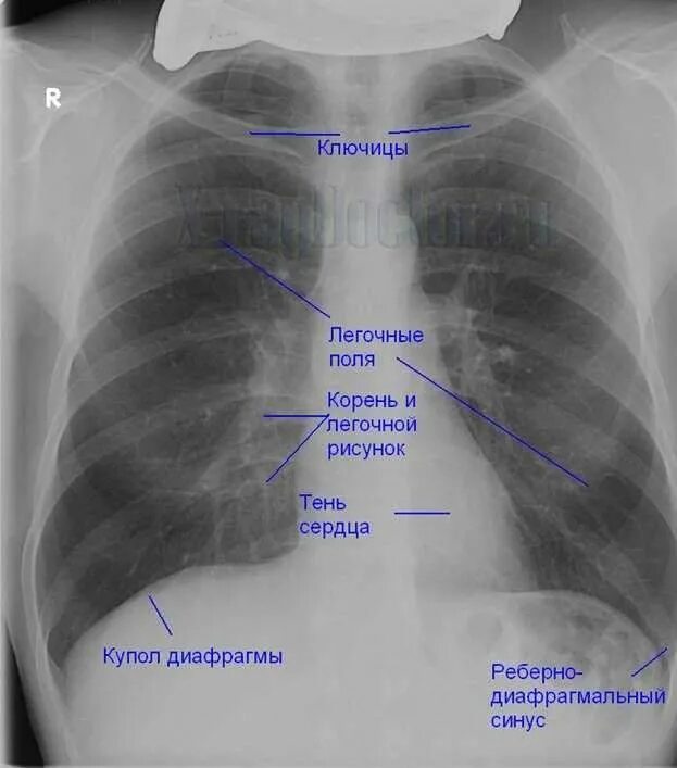 После флюорография можно можно кт делать. Снимок здоровых легких у человека на рентгене. Снимок легких здорового человека и больного пневмонией. Рентген грудной клетки больного пневмонией. Рентген легких пневмония отличия от здорового.