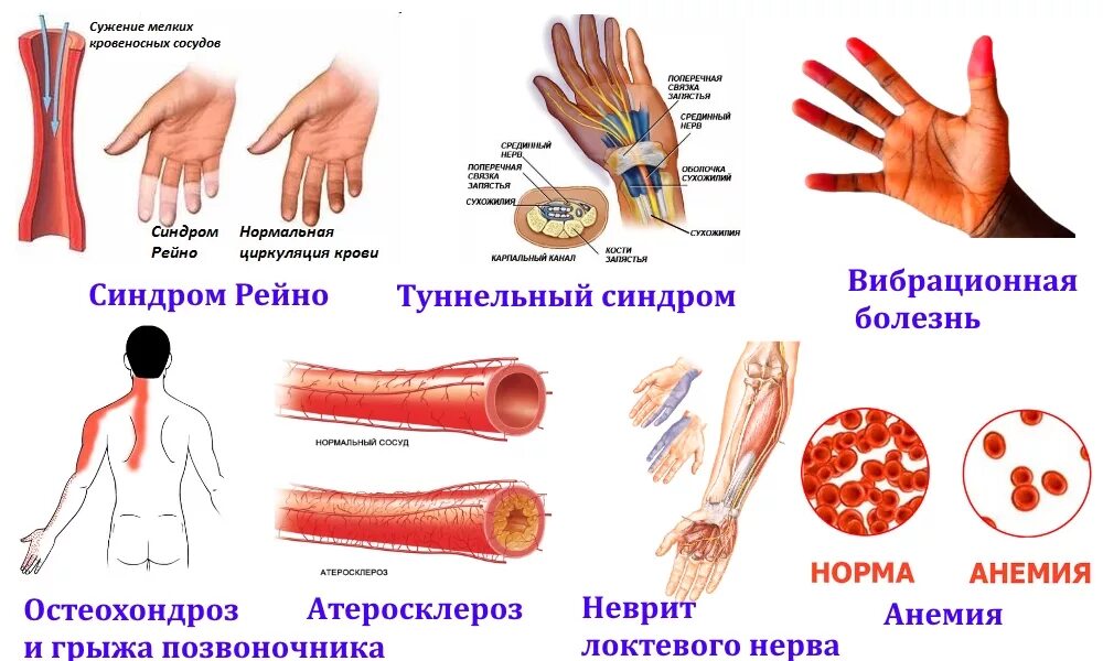 Сужение сосудов руки. Атеросклероз верхних конечностей симптомы. Вибрационная болезнь синдром Рейно. Заболевания сосудов верхних конечностей. Вибрационная болезнь рук.