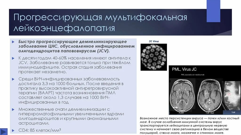 Многоочаговые поражения головного. Прогрессивная мультифокальная лейкоэнцефалопатия. ВИЧ ассоциированная лейкоэнцефалопатия мрт. Прогрессирующая сосудистая лейкоэнцефалопатия симптомы. Лейкоэнцефалопатия головного мозга кт.