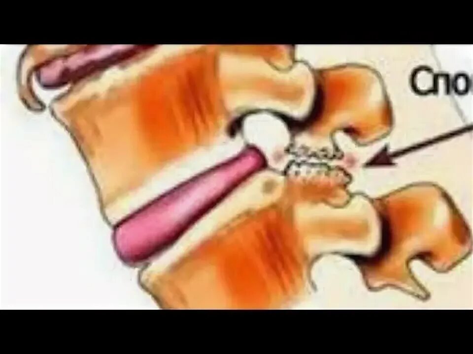 Остеофиты что это такое и как лечить. Остеофиты спондилез. Спондилёз шейного отдела позвоночника что это такое. Спондилез тазобедренного сустава. Шейный остеохондроз остеофиты.