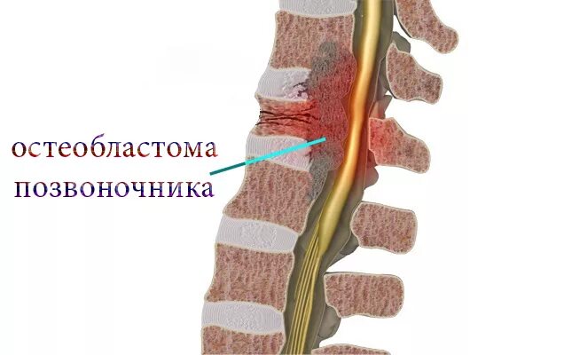 Рак поясницы. Опухоль спинного мозга поясничного отдела. Остеобластома позвонка. Опухоль позвоночника поясничного крестцового отдела.