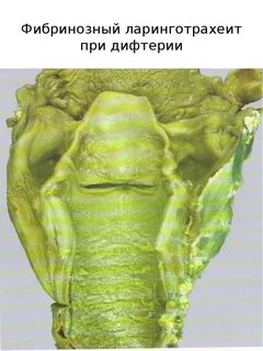 Брюшной тиф дифтерия