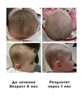 Кривая голова что делать