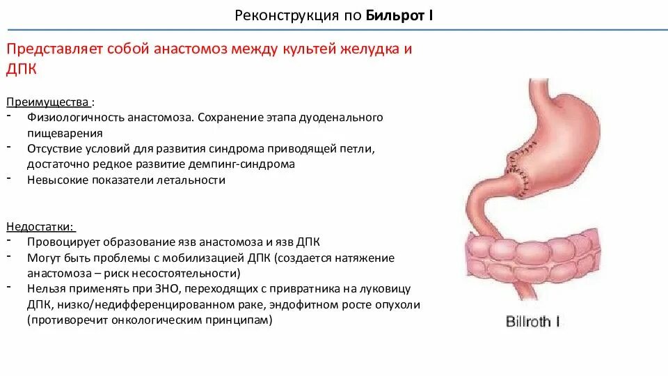 Последствия операции желудка. Схема резекции желудка по Бильрот 1. Бильрот 1 и Бильрот 2 отличия. Схема резекции желудка по Бильрот 1 Бильрот 2. Операции на желудке Бильрот 1 и 2.