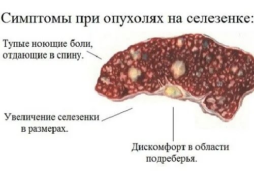 Где на0одитсясеоезенка. Злокачественные опухоли селезенки. Где на0одитсясеоезенка. Висцеральная поверхность селезенки анатомия. Селезенка строение и функции.