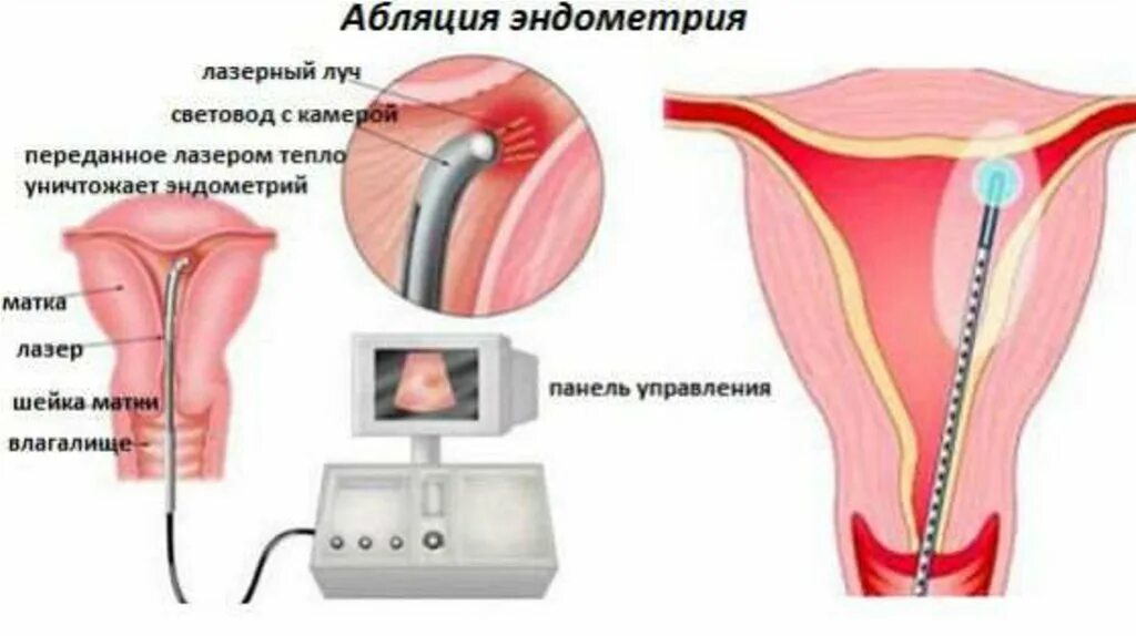 Что такое эндометрия у женщин в матке. Термоаблация эндометрия. баллонная абляция эндометрия. лазерная аблация эндометрия.