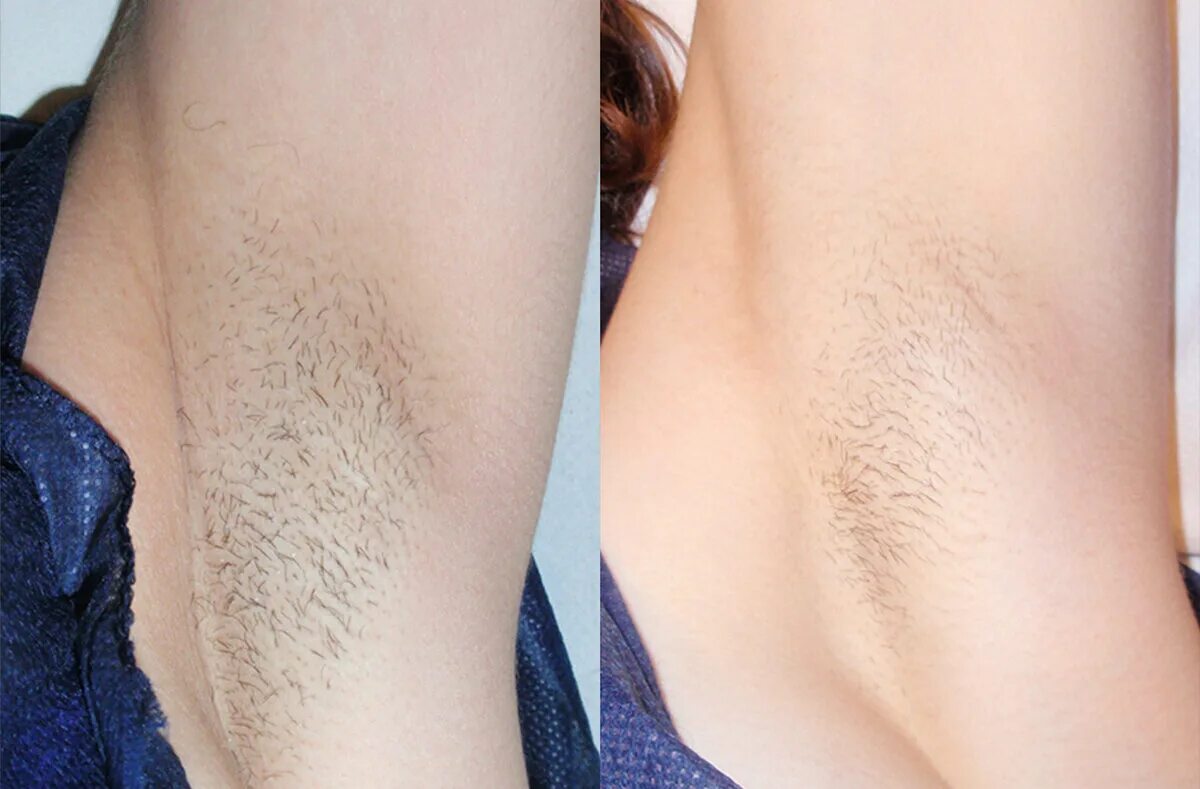 Как выглядит лазерная эпиляция. Фотоэпиляция элос. ipl элос эпиляция. депиляция подмышек.