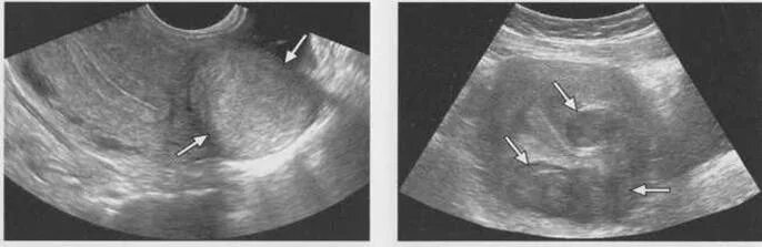 Интрамуральная миома матки УЗИ. Интерстициальная миома матки на УЗИ. Эндометрия скудная