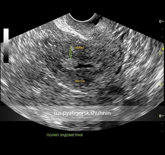 Полип полости матки на УЗИ. Эхограммы полип эндометрия. Полип в эндометрии матки отзывы