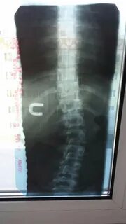 Сколиоз отзывы 2 степень