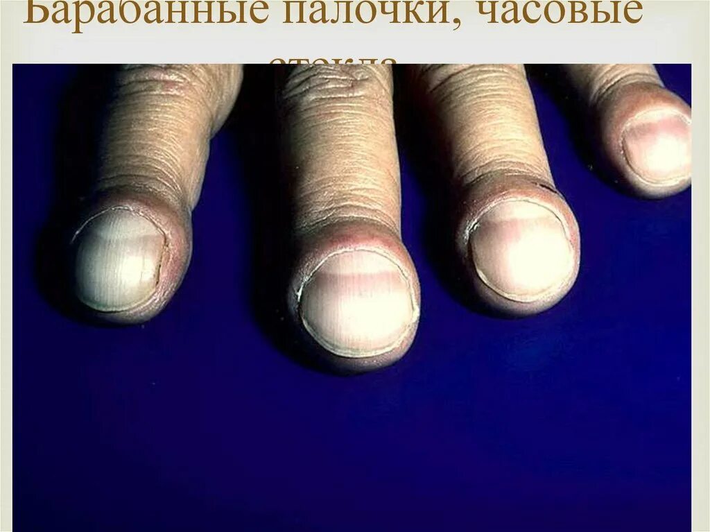 Трубчатые пальцы. Барабанные палочки ногти гиппократа. ногти гиппократа барабанные пальцы. часовые стекла.