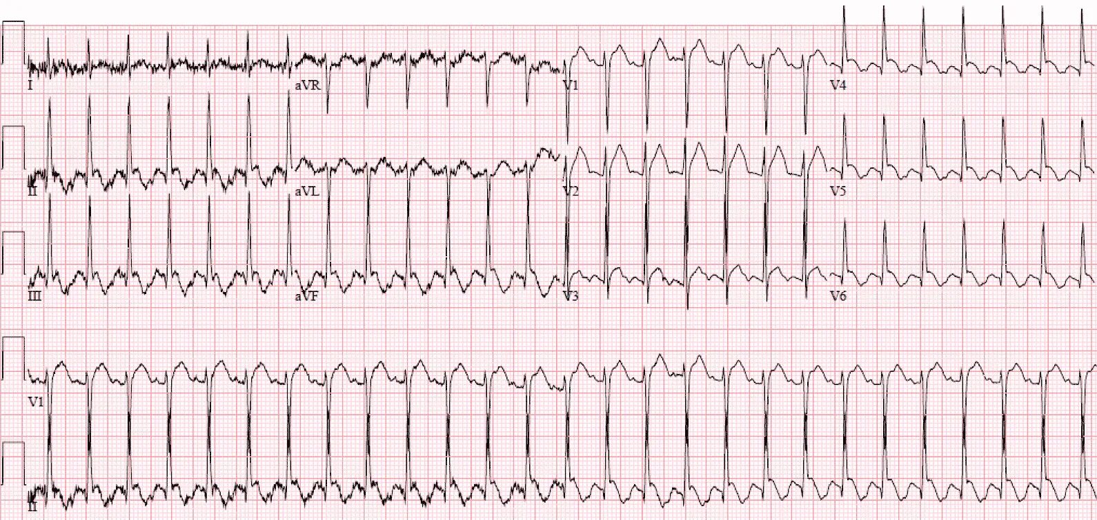 Синусовая тахикардия вертикальное. Пароксизмальная наджелудочковая тахикардия ЭКГ. Суправентрикулярная пароксизмальная тахикардия на ЭКГ. Наджелудочковая тахикардия на ЭКГ. Предсердная пароксизмальная тахикардия на ЭКГ.
