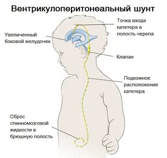 Как лечить черепной