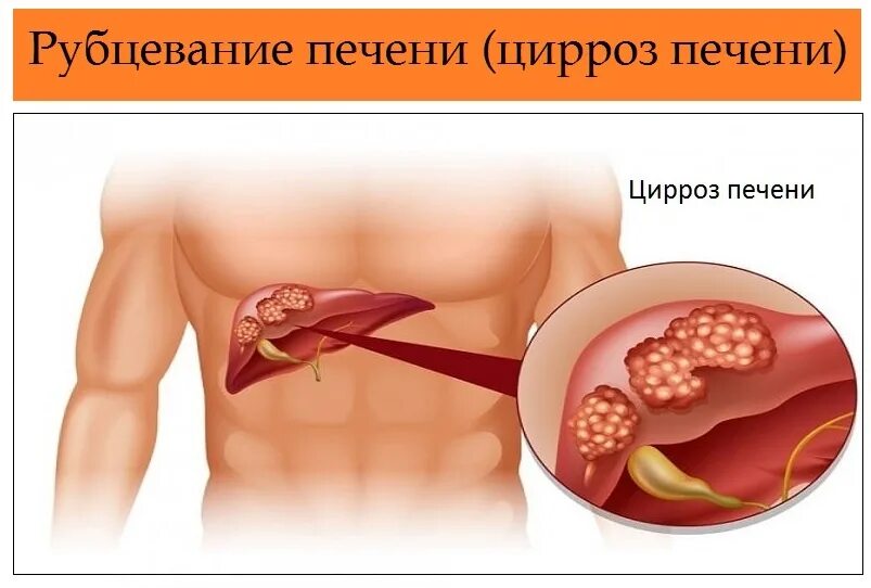 Боли в области печени причины. Цирроз печени симптомы у женщин. Цирроз печени запущенная форма.