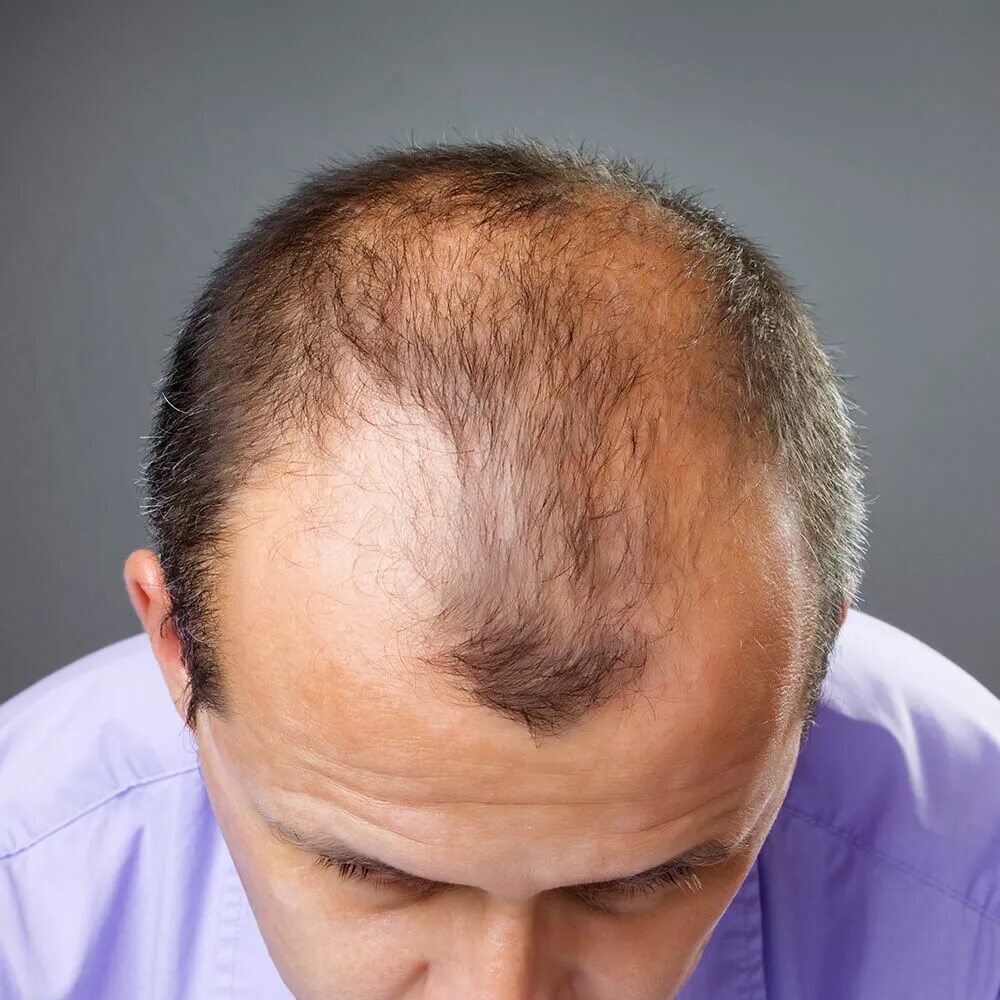 Лысеет лоб. Очаговая алопеция (alopecia Areata). Редкие волосы. Прически с облысением.